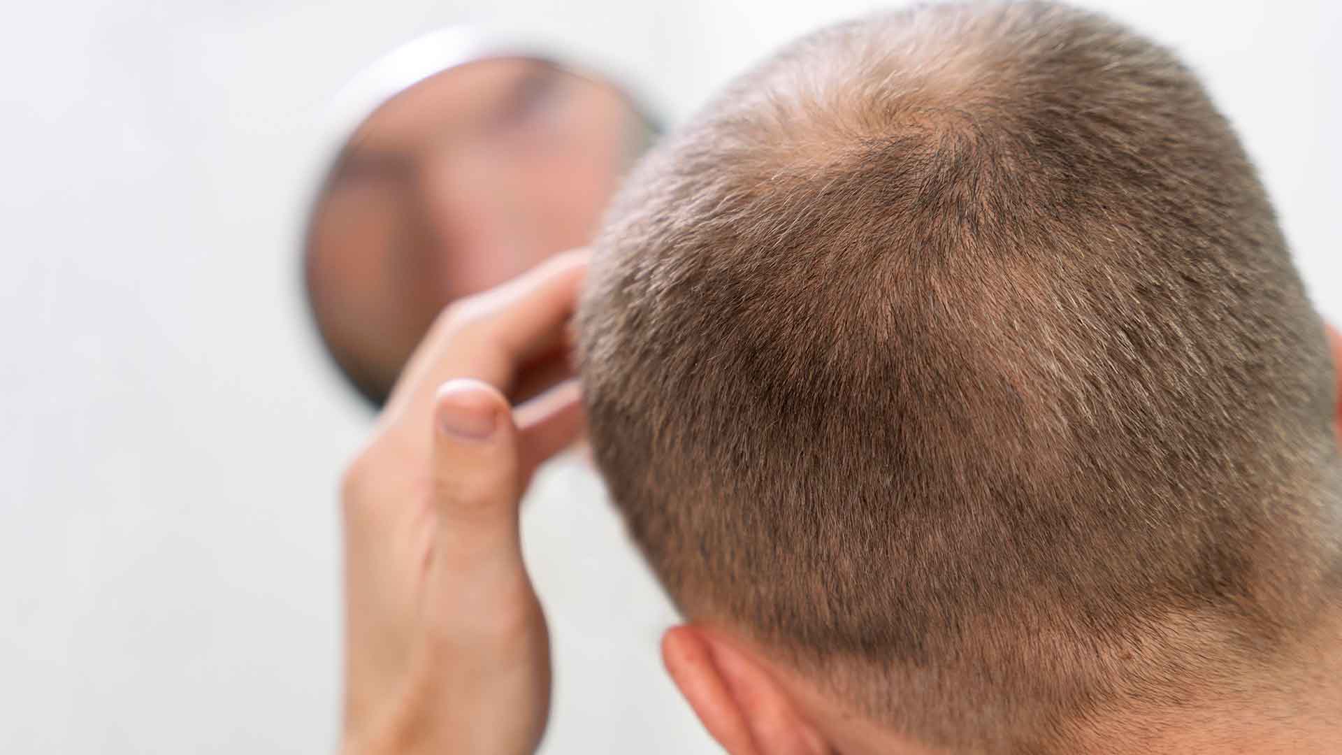 hairloss-2